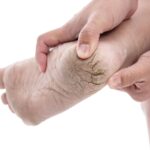 Kitchen Remedies For Cracked Heels